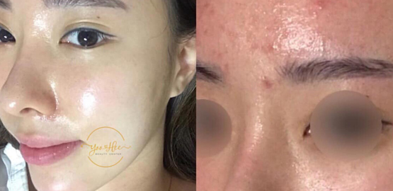 TRỊ MỤN CHUYÊN SÂU